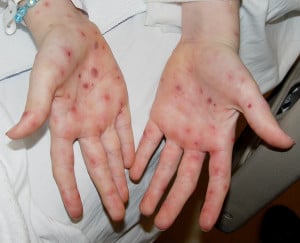 palms soles rash