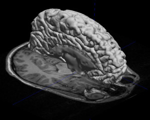 mri_overlay5
