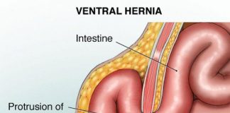 hernias and types