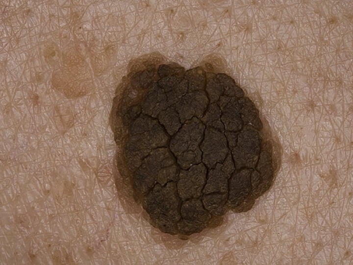 Seborrheic keratosis