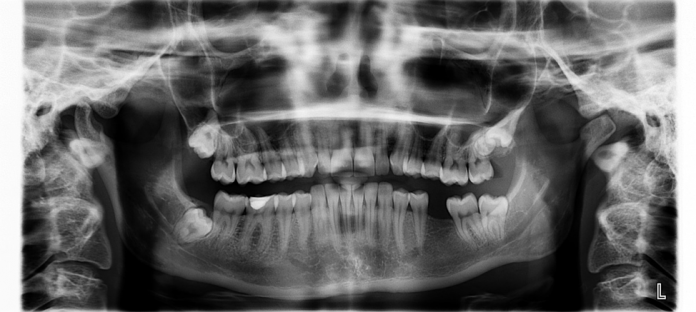 dental implants
